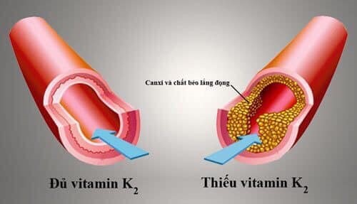 K2 trong Natto  loại bỏ cặn canxi trong mạch máu