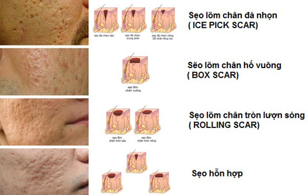 PHÂN LOẠI VÀ CÁCH TRỊ SẸO MỤN HIỆU QUẢ