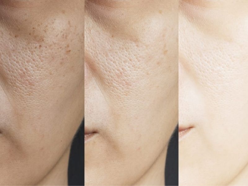hydroquinone la gi 3