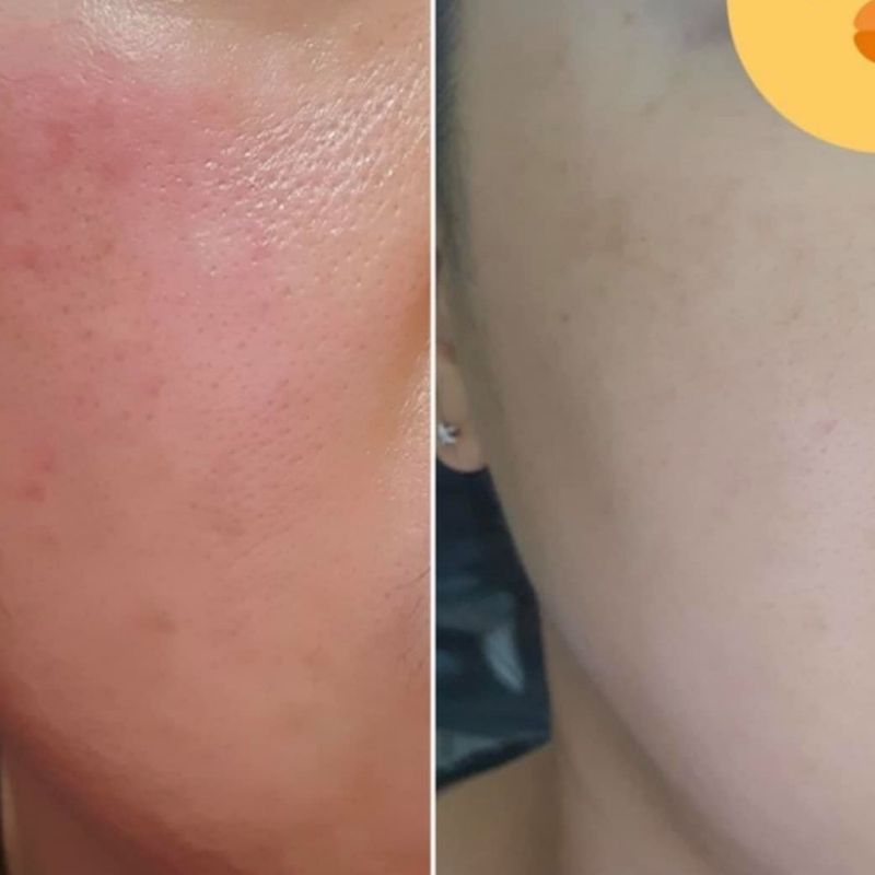 Kem phục hồi Repair Derm Cica Pro dành cho da mụn, nhạy cảm bị tổn thương