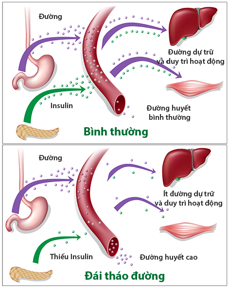 Đái tháo đường típ 2 nguy hiểm đến sức khỏe