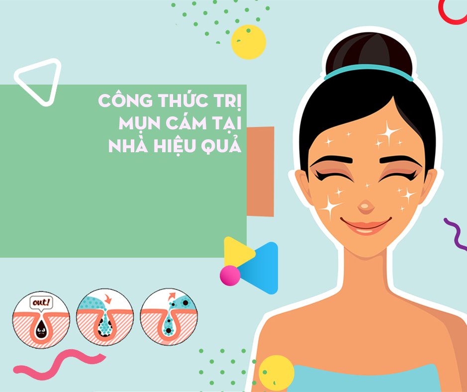 CÔNG THỨC TRỊ MỤN CÁM TẠI NHÀ HIỆU QUẢ