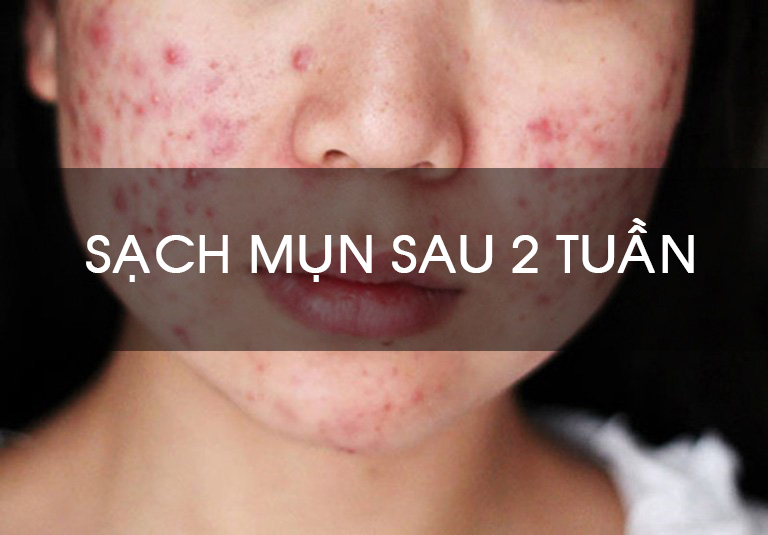 Cách chăm sóc da mụn giúp sạch mụn chỉ sau 2 tuần