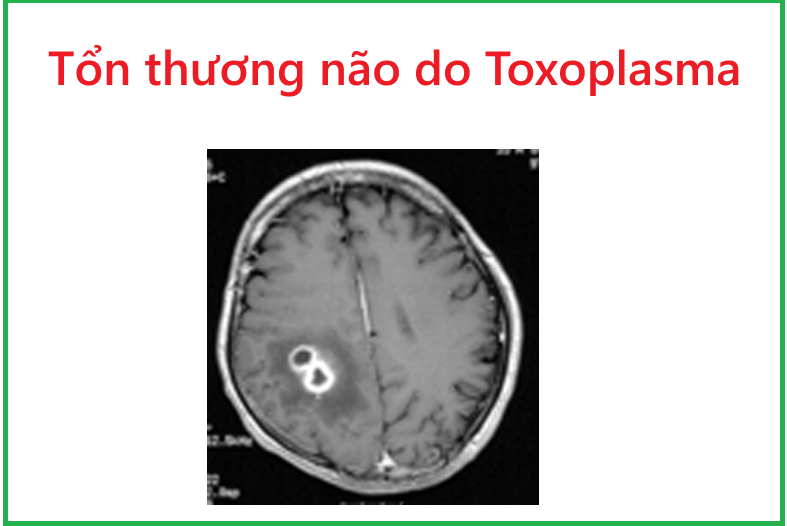 Toxoplasma não ở bệnh nhân HIV