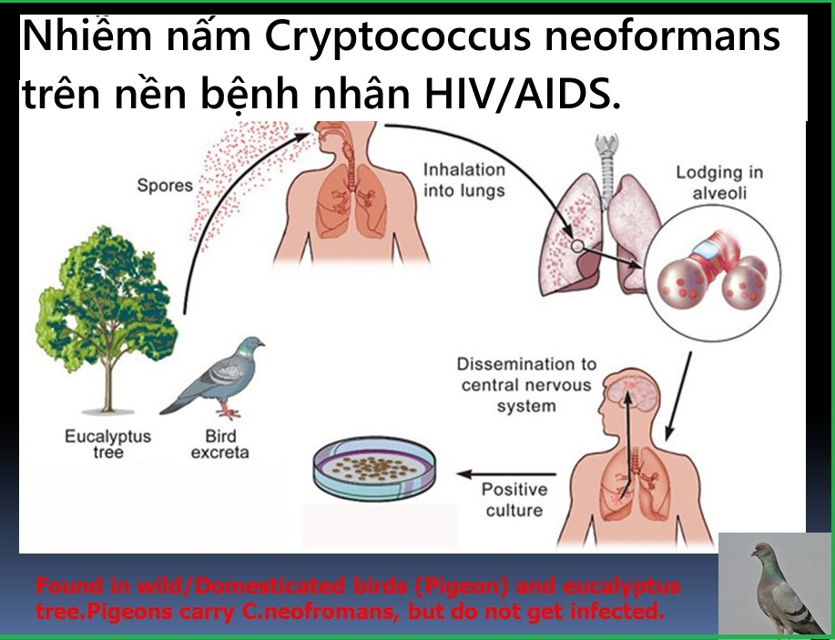 Nhiễm nấm Cryptococcus neoformans ở bệnh nhân HIV