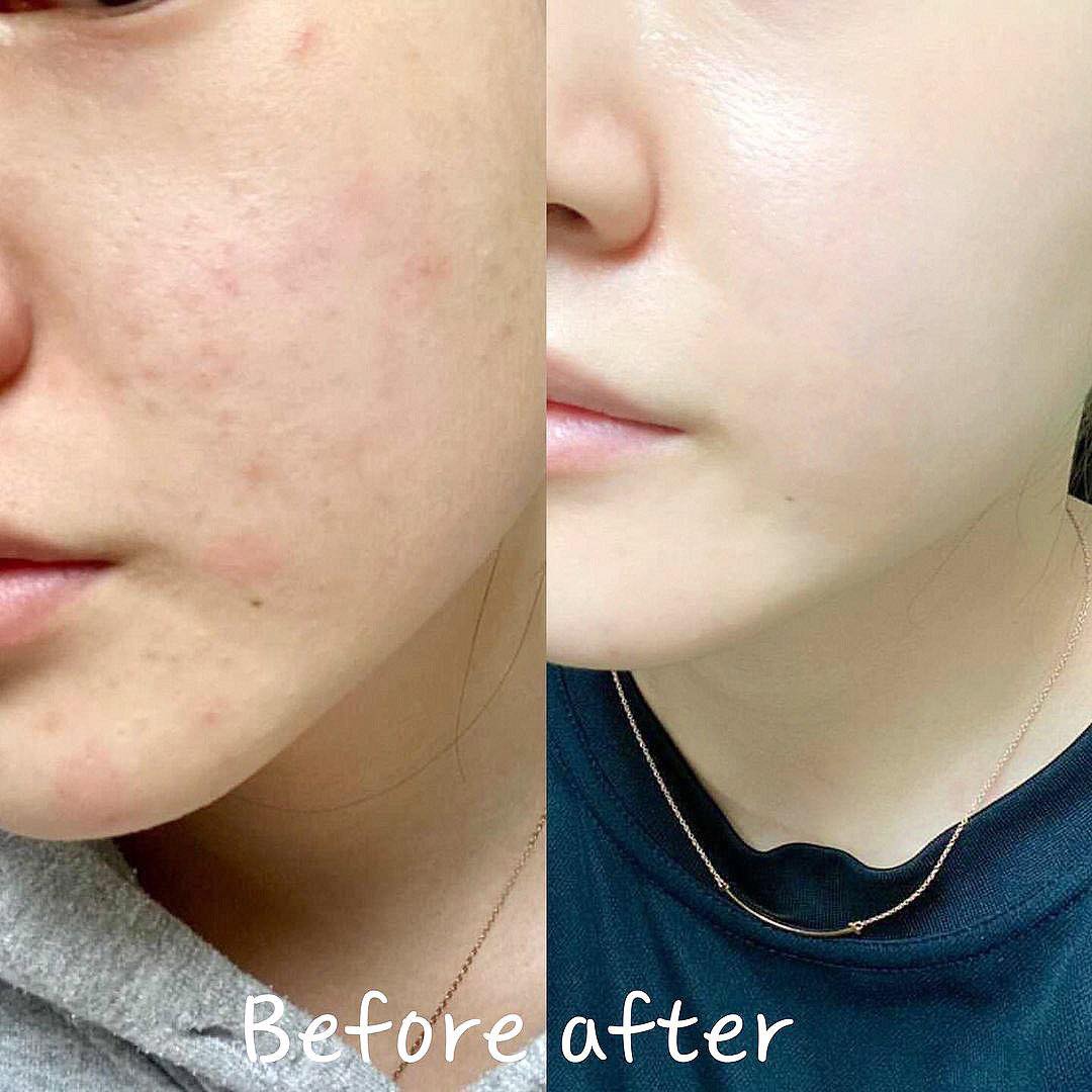 serum-duong-trang-mo-tham-neogen