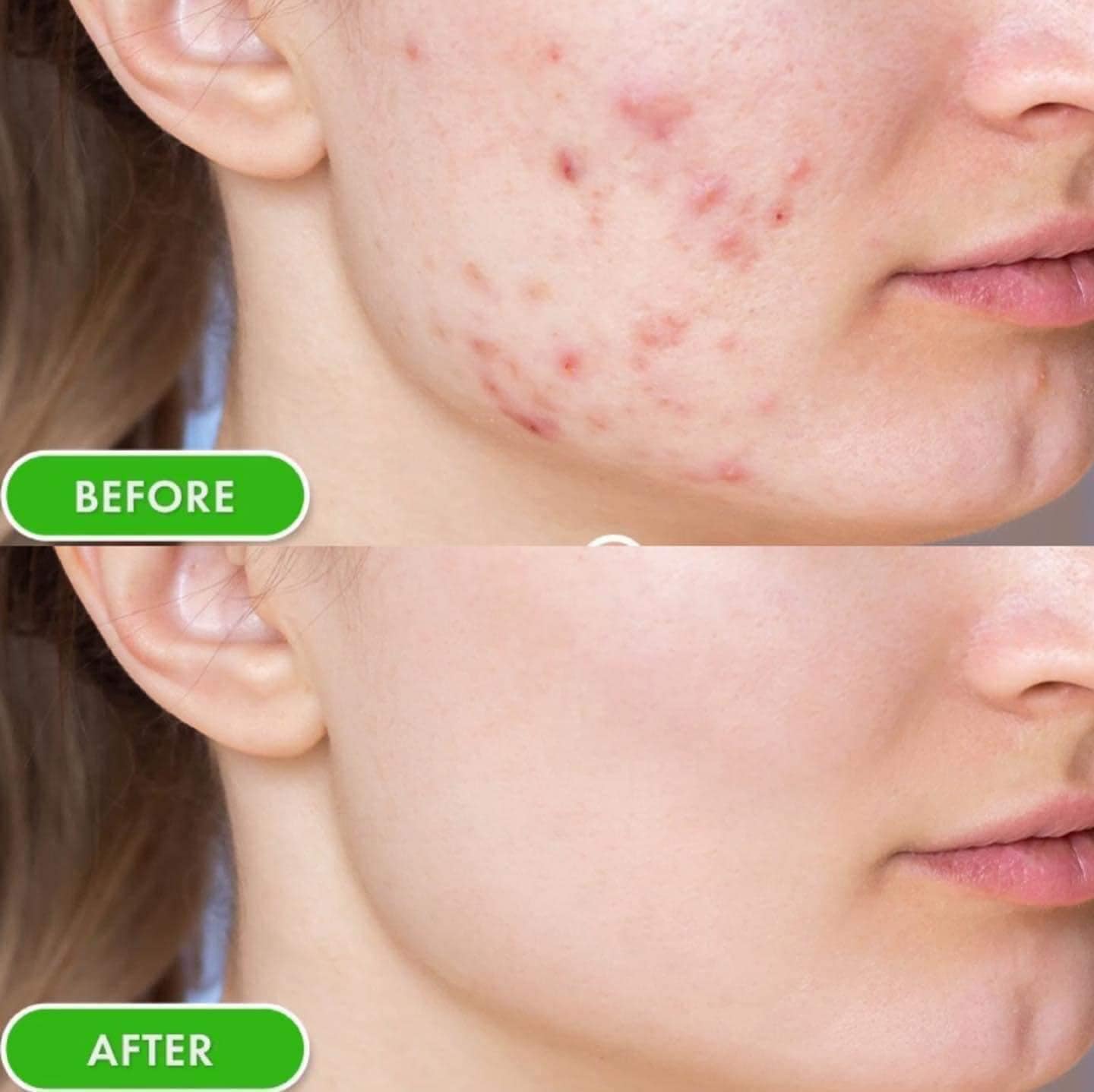 kem-duong-giam-mun-svr-active-gel