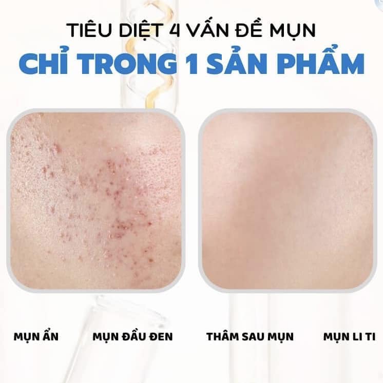 gel-tri-mun-giam-tham-ezanic-gel-20