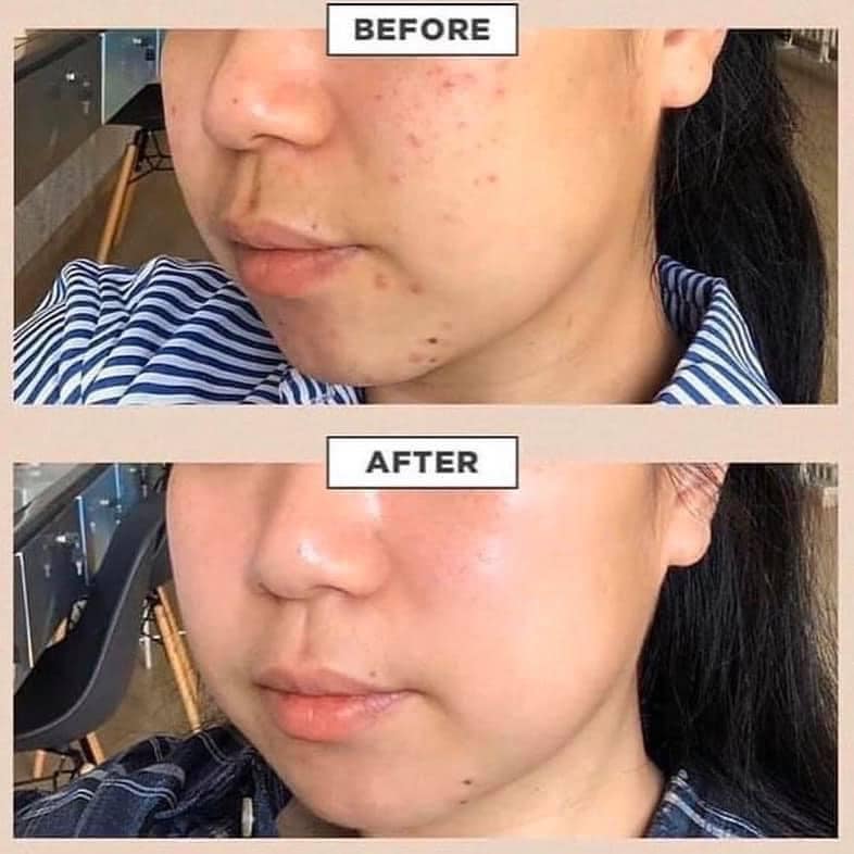 serum-rau-ma-phuc-hoi-da-skin1004-centella