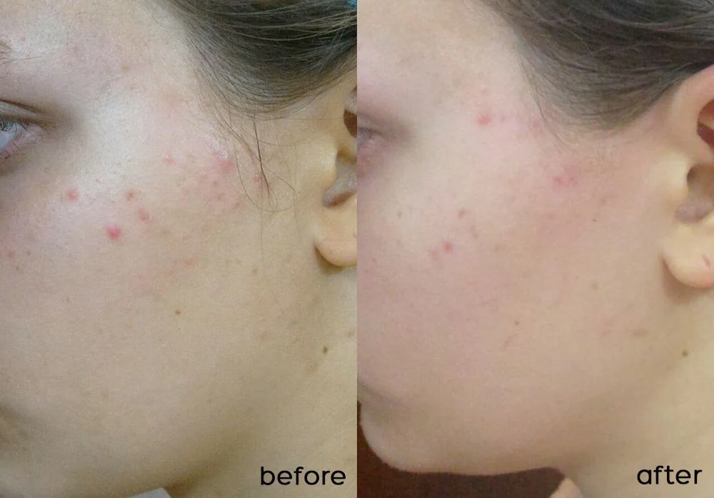kem-duong-da-dau-mun-svr-mat-pores-sebiaclear