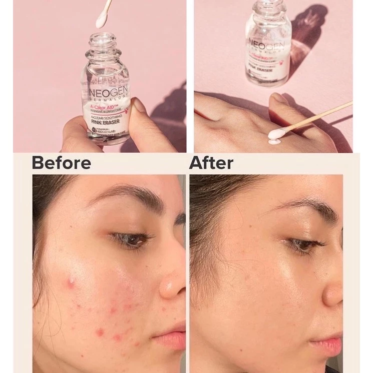 cham-mun-giam-sung-viem-neogen-dermalogy