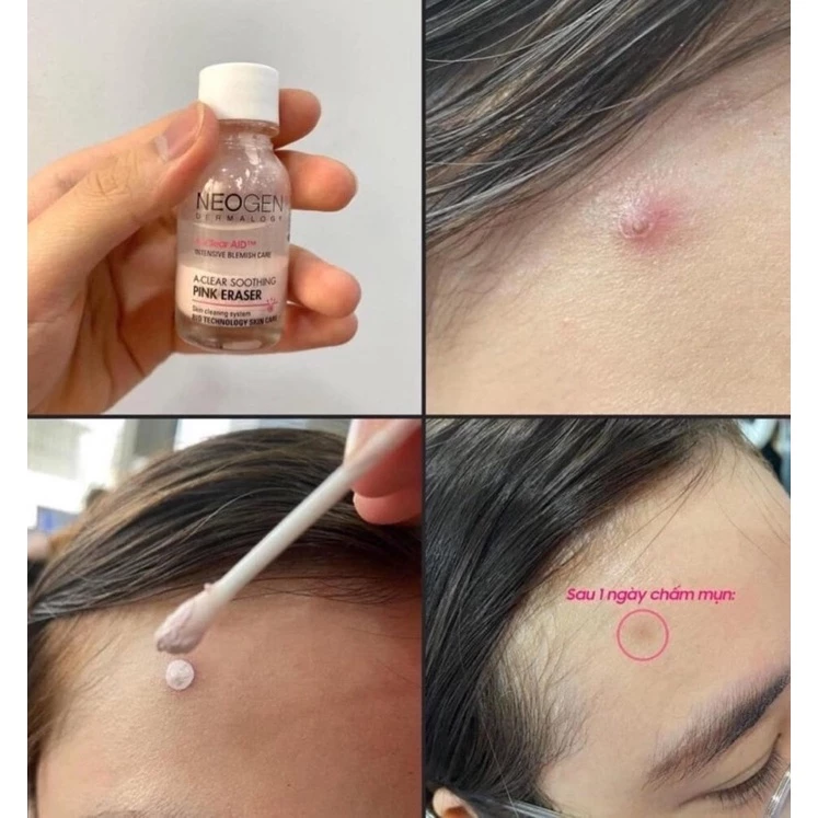 cham-mun-giam-sung-viem-neogen-dermalogy