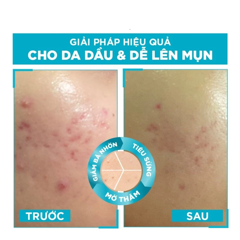 serum-ngua-mun-mo-tham-garnier