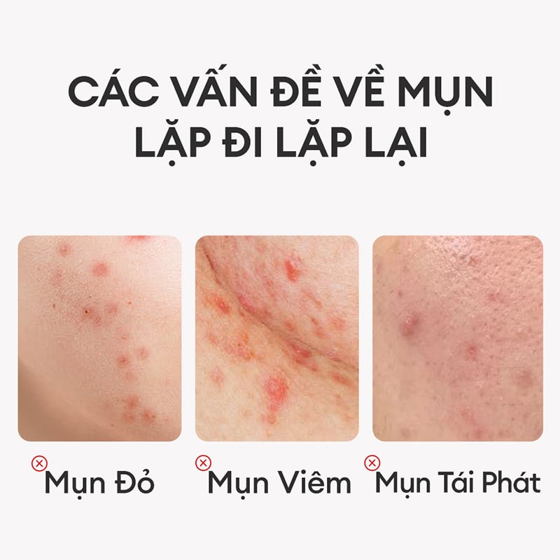 https://myphamkissme.com/kem-ho-tro-giam-mun-colorkey-tra-xanh