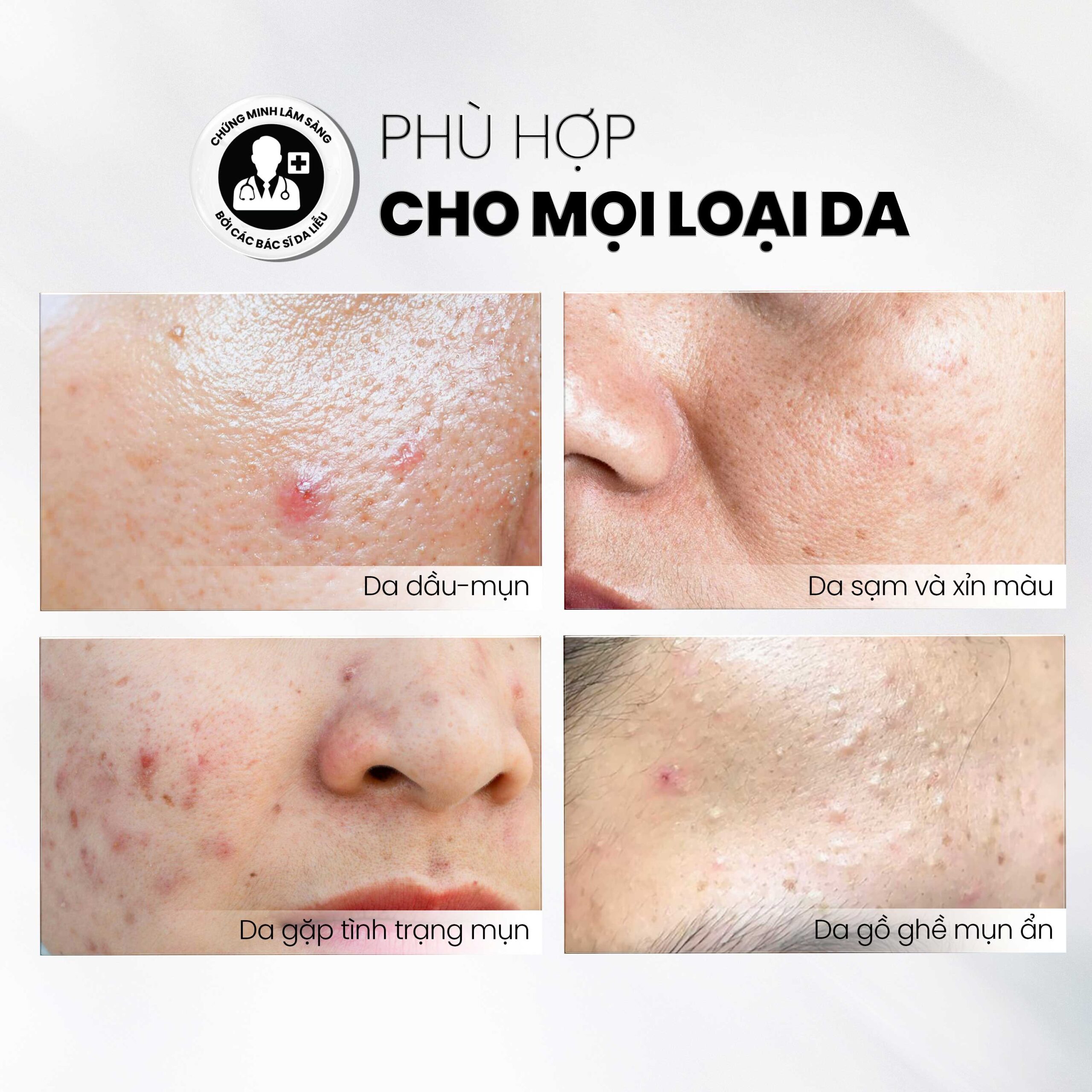 tẩy tế bào chết MD CARE AntiAc Exfo