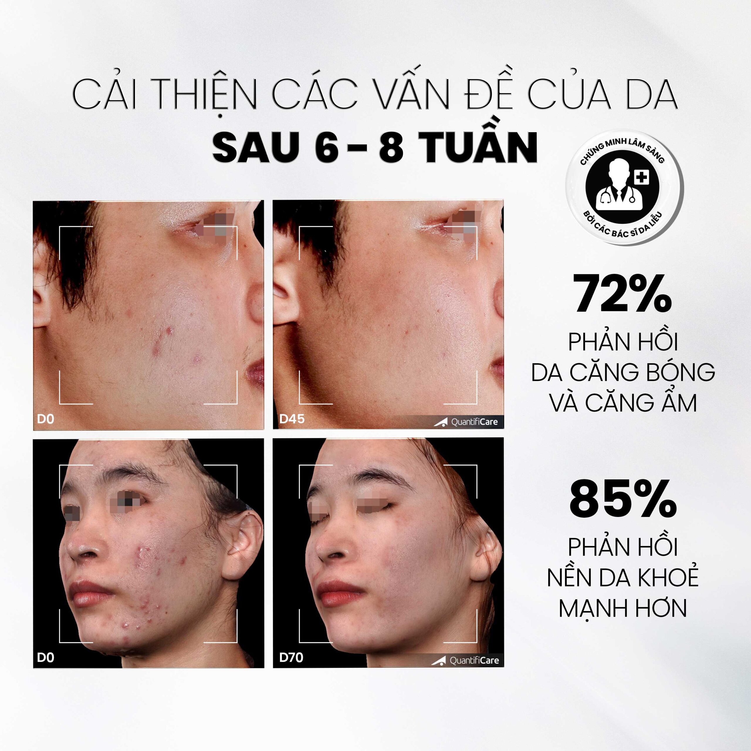 tẩy tế bào chết MD CARE AntiAc Exfo