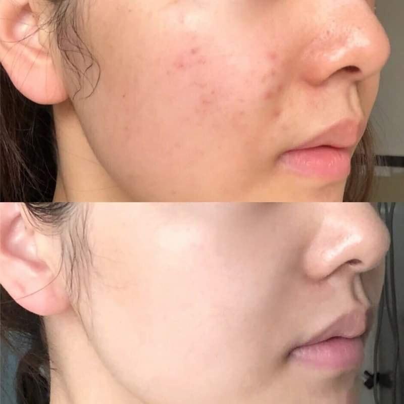 https://myphamkissme.com/kem-duong-babe-stop-akn-moisturiser