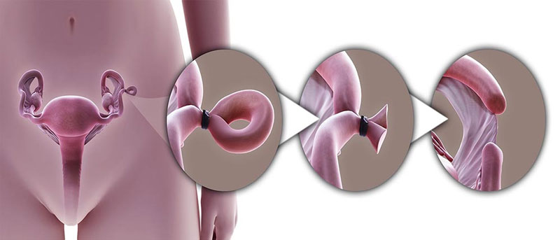 Triệt Sản Ở Nữ Giới Có Hại Không? Giải Đáp Về Khả Năng Sinh Con Sau Khi Triệt Sản