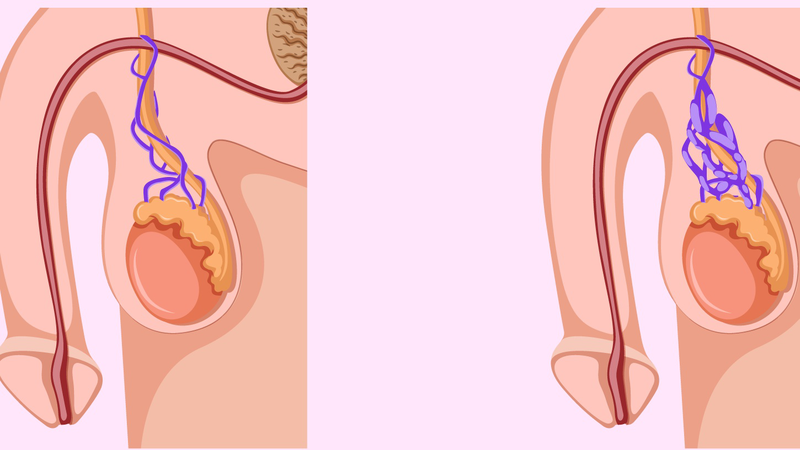 Giãn Tĩnh Mạch Thừng Tinh Có Con Được Không? Có Cần Can Thiệp Không?