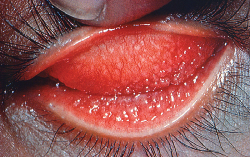 Bệnh Chlamydia Có Chữa Được Không? Cách Phòng Chống Hiệu Quả Từ Chuyên Gia