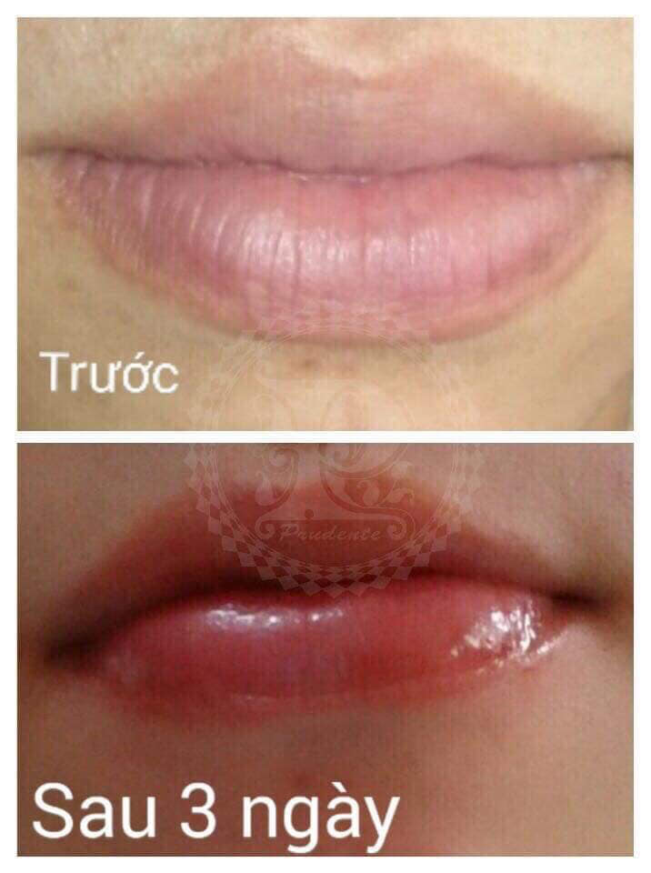Hồng môi trước và sau