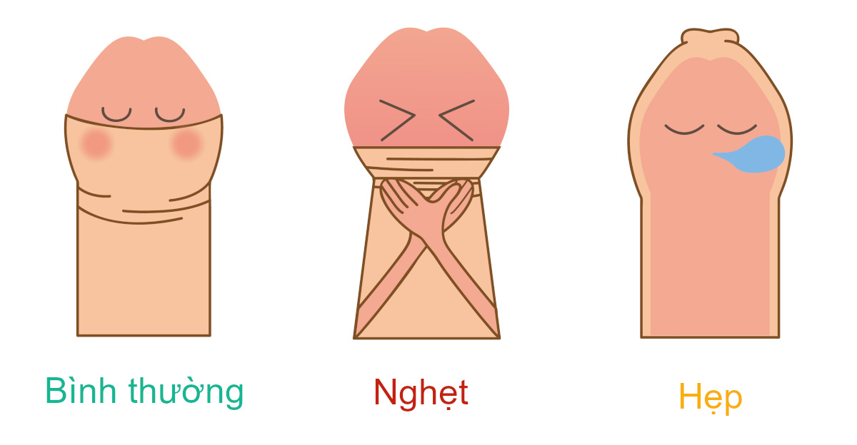 Cắt Bao Quy Đầu Bao Lâu Thì Quan Hệ Được? Giải Đáp Chi Tiết Cho Nam Giới