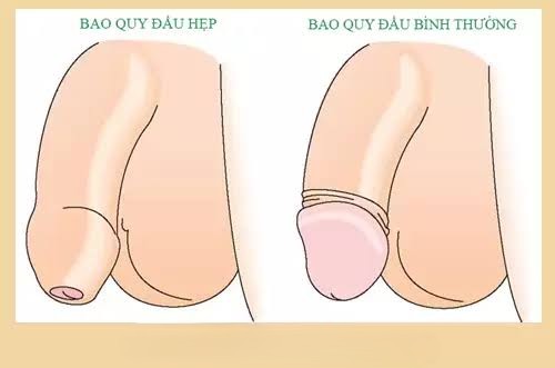 Cắt Bao Quy Đầu Có Ảnh Hưởng Gì Không? Lợi Ích Và Rủi Ro Cần Biết