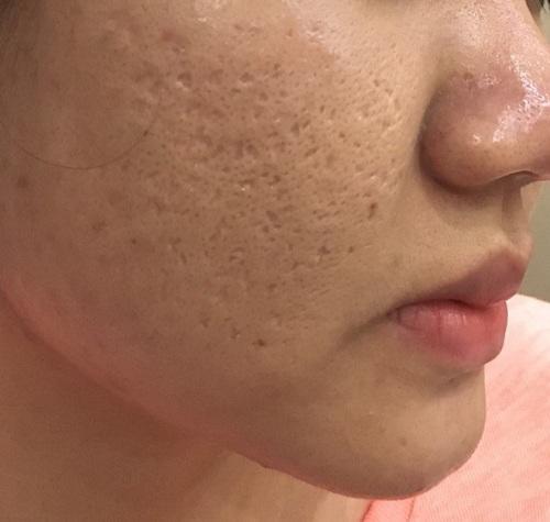 trị sẹo rỗ
