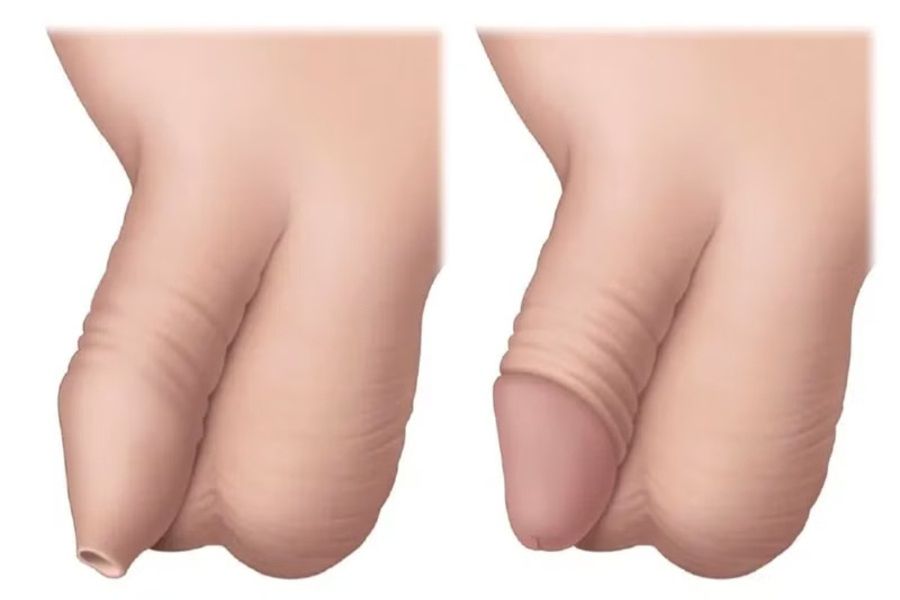 Chữa Lột Bao Quy Đầu Có Quan Hệ Được Không? Thời Gian Kiêng Và Lưu Ý Quan Trọng