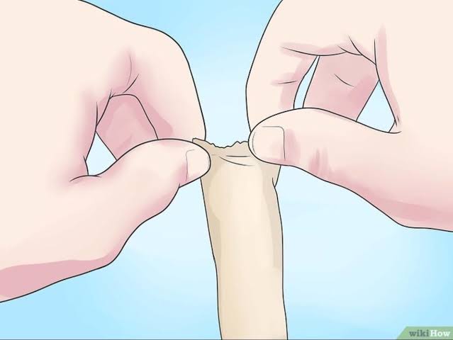 Chữa Lột Bao Quy Đầu Có Quan Hệ Được Không? Thời Gian Kiêng Và Lưu Ý Quan Trọng