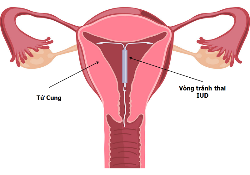 Đặt Vòng Tránh Thai: Khi Nào Nên Đặt Và Có An Toàn Không?