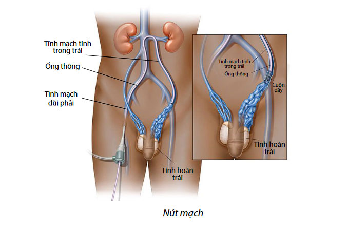 Giãn Tĩnh Mạch Thừng Tinh Có Con Được Không? Có Cần Can Thiệp Không?