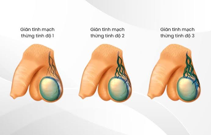 Giãn Tĩnh Mạch Thừng Tinh Có Con Được Không? Có Cần Can Thiệp Không?