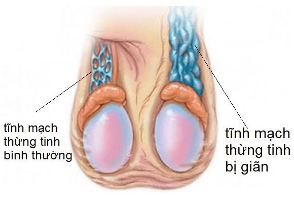 Giãn Tĩnh Mạch Thừng Tinh Có Con Được Không? Có Cần Can Thiệp Không?
