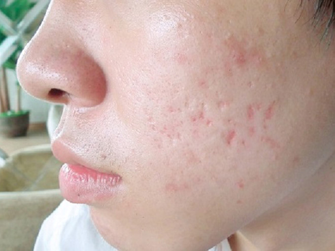Kem trị sẹo mụn