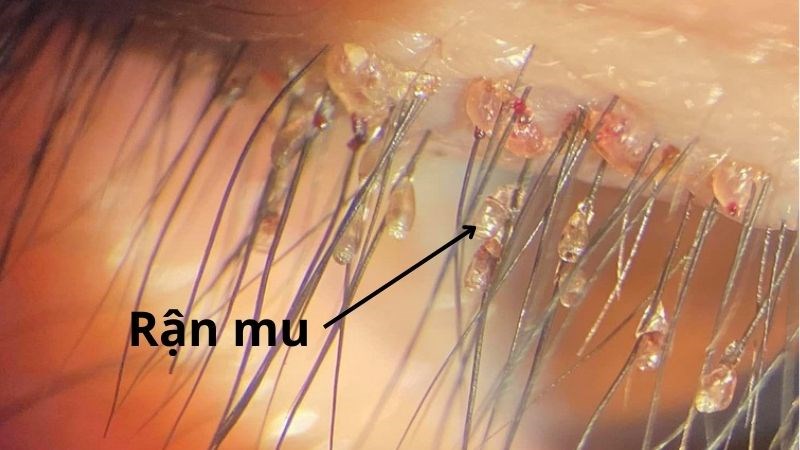 Lông vùng kín cứng và xoăn có bình thường không? Giải đáp chi tiết từ A-Z