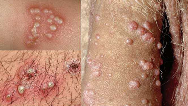 Mụn Rộp Sinh Dục Là Bệnh Gì? Dấu Hiệu, Nguyên Nhân Và Cách Điều Trị