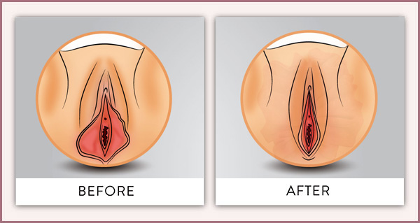 Nguyên Nhân Và Cách Khắc Phục Tình Trạng Môi Lớn Chảy Xệ An Toàn