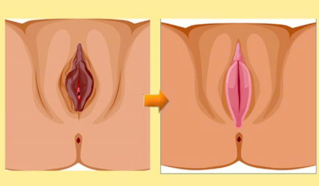 Nguyên Nhân Và Cách Khắc Phục Tình Trạng Môi Lớn Chảy Xệ An Toàn