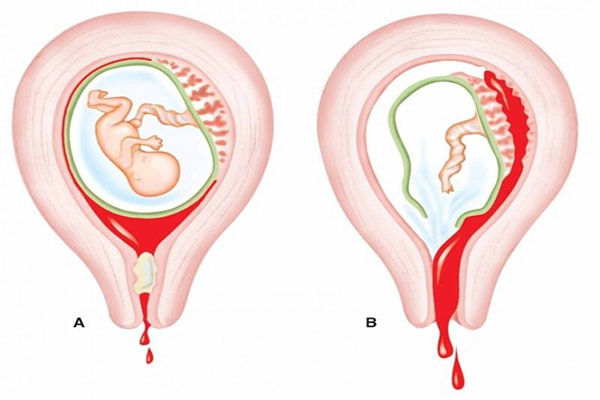 Phá Thai Có Dẫn Đến Vô Sinh Không? Nguy Cơ Ảnh Hưởng Đến Khả Năng Sinh Con