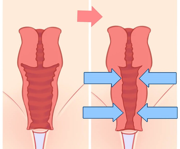 Phẫu thuật thu nhỏ âm hộ nhưng điều nên biết mà lưu ý