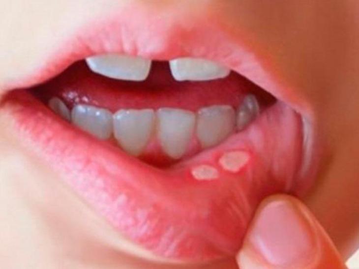 Quan Hệ Bằng Miệng Có Bị Nhiệt Miệng Không? Cách Xử Lý Và Phòng Tránh