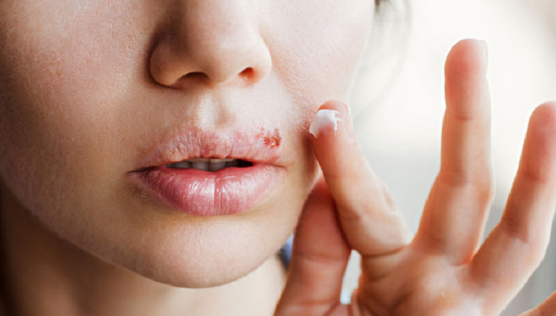 Quan Hệ Bằng Miệng Có Bị Nhiệt Miệng Không? Cách Xử Lý Và Phòng Tránh
