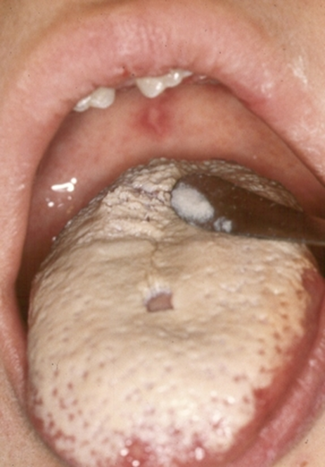 Quan Hệ Bằng Miệng Có Lây Nấm Candida Không? Cơ Chế Và Yếu Tố Tăng Nguy Cơ