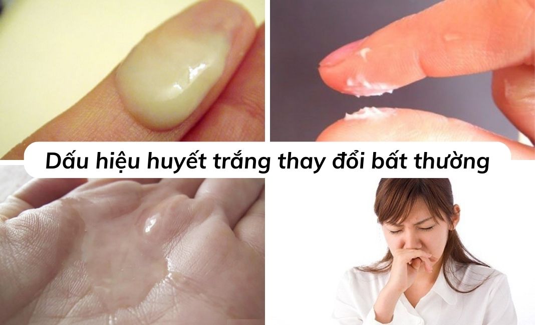 Huyết Trắng Ở Phụ Nữ: Dấu Hiệu Sinh Lý Bình Thường Hay Cảnh Báo Bệnh?