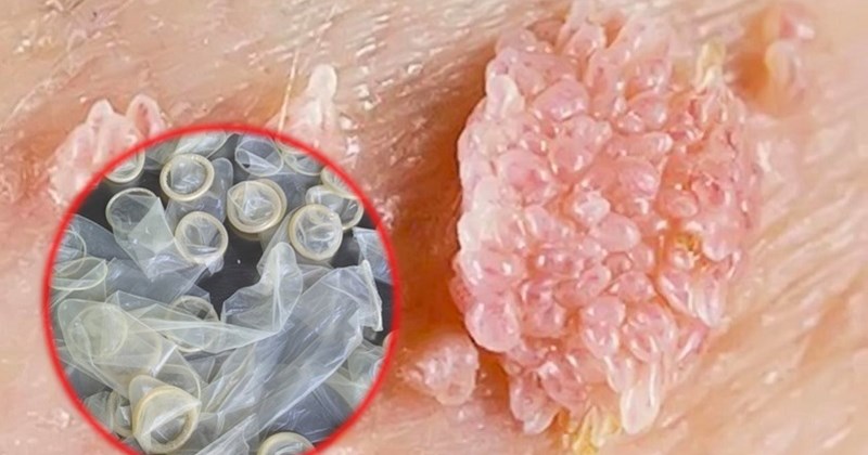 Tác Hại Khi Dùng Bao Cao Su Giả: Nguy Cơ Sức Khỏe Và Cách Nhận Biết Hàng Giả Hiệu Quả