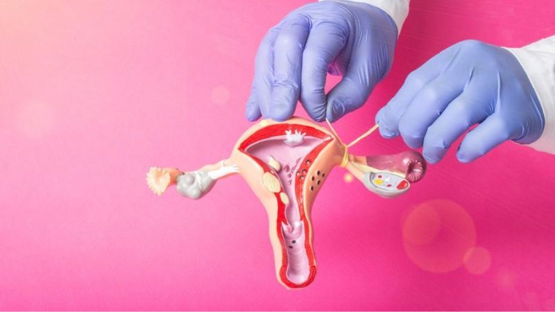 Thắt Ống Dẫn Trứng Là Gì? Lợi Ích, Rủi Ro Và Những Lưu Ý Quan Trọng