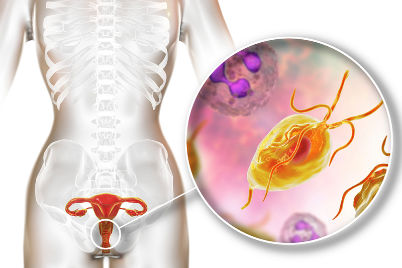 Trichomoniasis Là Bệnh Gì? Lây Qua Đâu Và Dấu Hiệu Cần Nhận Biết