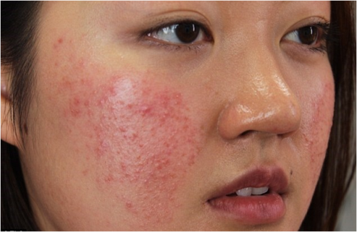 Làn da bị mẩn đỏ do không tẩy trang