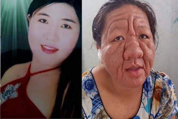 Các dấu hiệu nhận biết da bị nhiễm độc Corticoid Các dấu hiệu nhận biết da bị nhiễm độc Corticoid